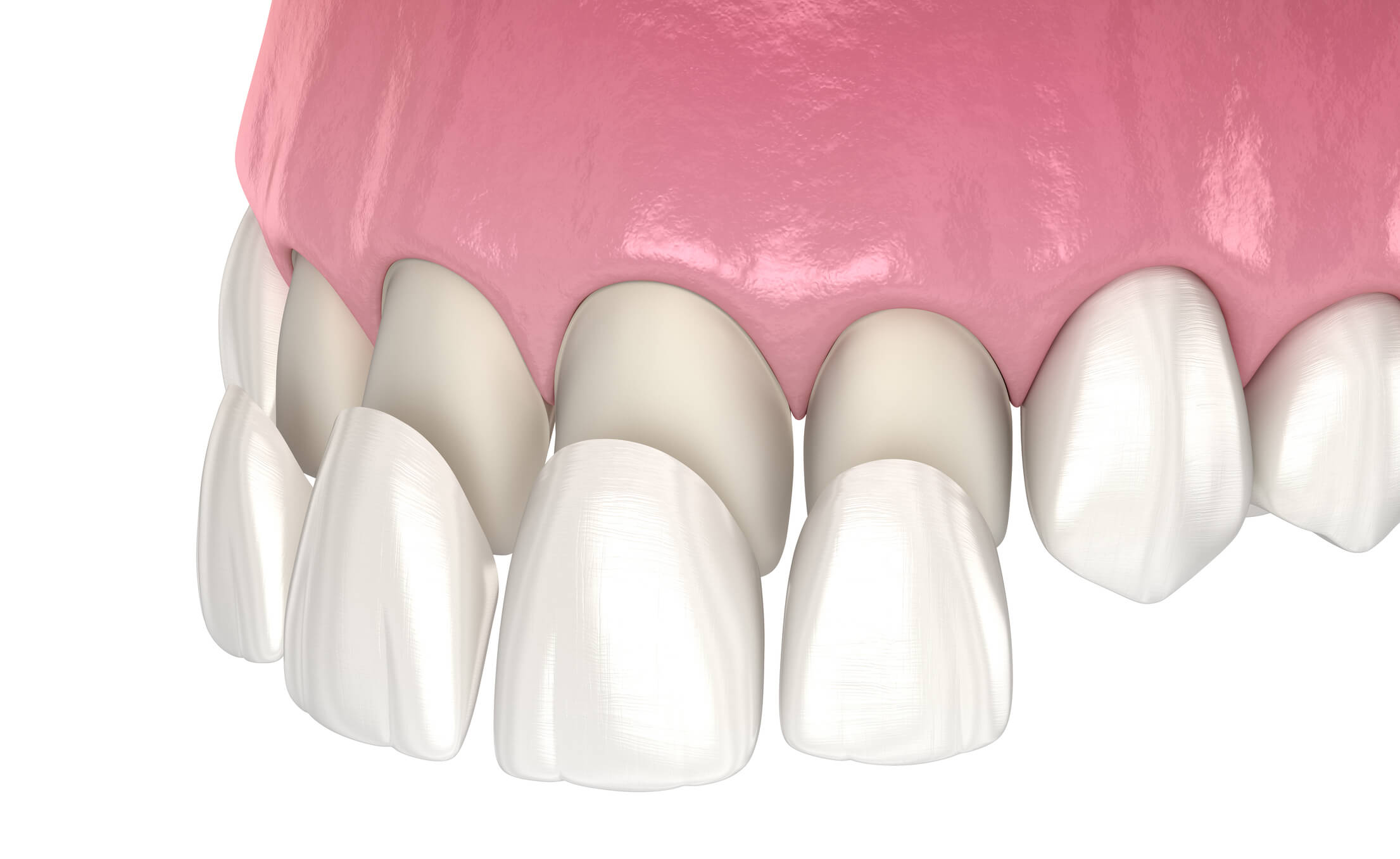 Cosmetic Veneers and Crowns