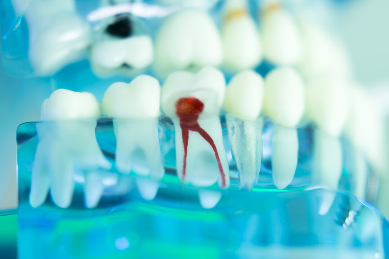 Root Canals